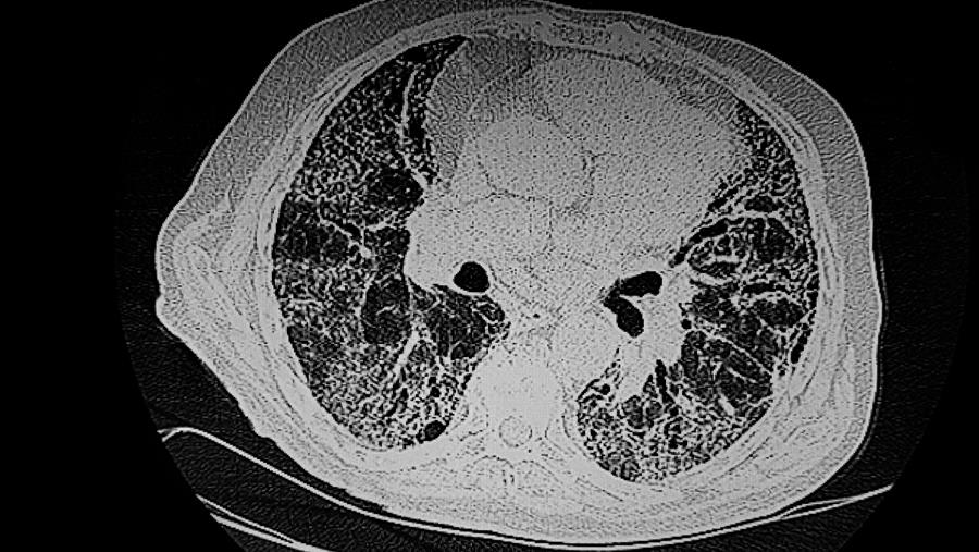 Treprostinil via inhalatie verbetert longfunctie bij idiopathische longfibrose