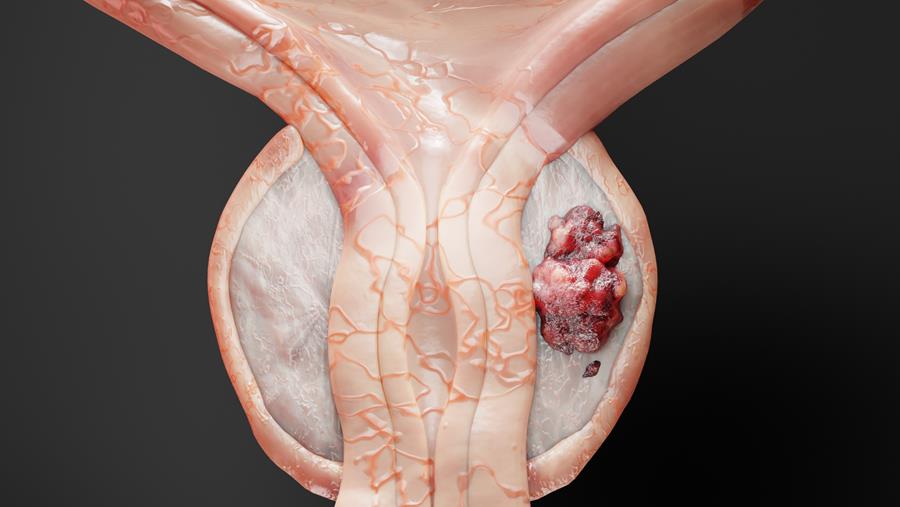 Cancer de la prostate : Le prometteur traitement local des métastases