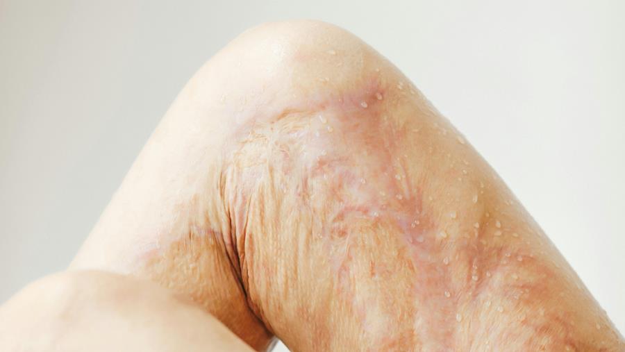 "Revalidatie van slachtoffers kan maanden tot jaren duren"