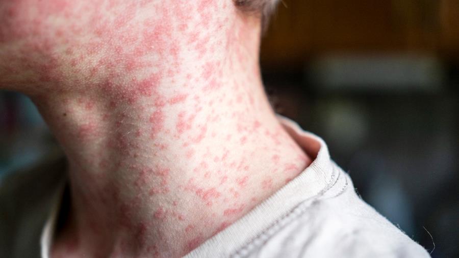 Rougeole : ensemble pour une protection plus précoce et efficace