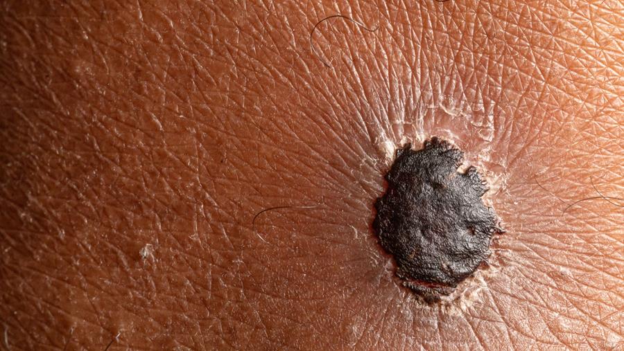 Thérapie néoadjuvante dans le mélanome résécable : données actualisées