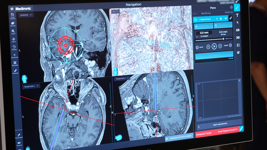 Une neurochirurgie inédite dans l'épilepsie réfractaire [Cliniques Saint-Luc]