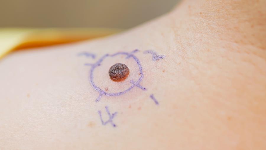 Mélanome : le bénéfice du nivolumab confirmé à 9 ans
